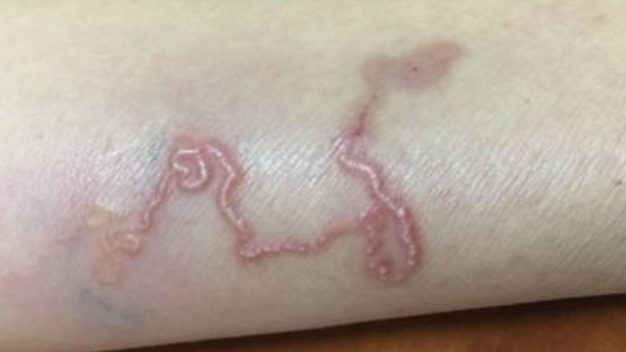 Thói quen ăn món tái sống khiến người đàn ông nhiễm 2 loại ký sinh trùng